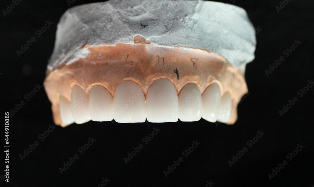 Dental veneers for new smile Dental veneers for new smile