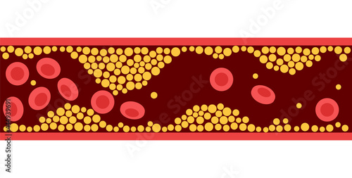 Cholesterol and atherosclerosis