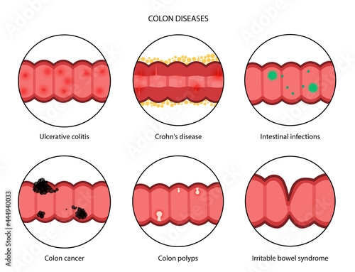 Intestines diseases concept