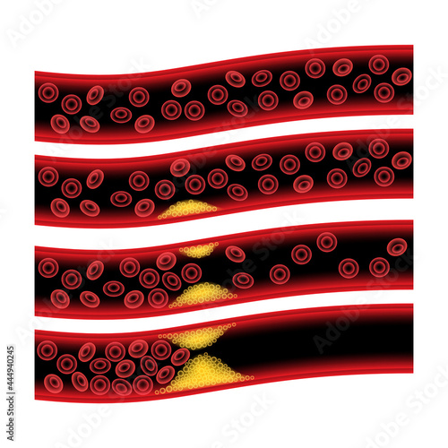 Cholesterol and atherosclerosis