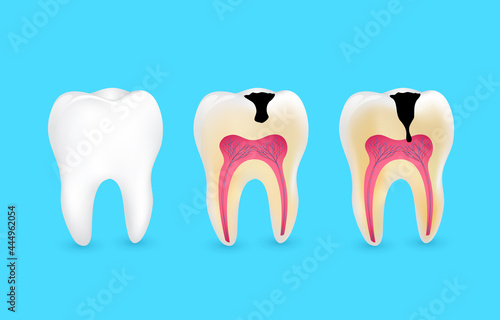 Healthy tooth and tooth caries. Superficial caries; deep caries; enamel and dentin decay; periodontitis.