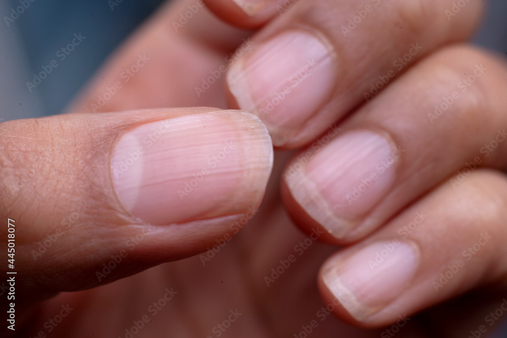 Battered nails Battered nails