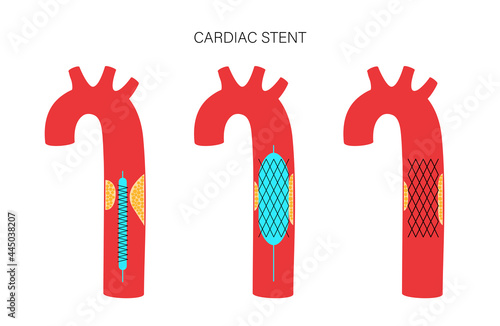 Angioplasty cardiac stent