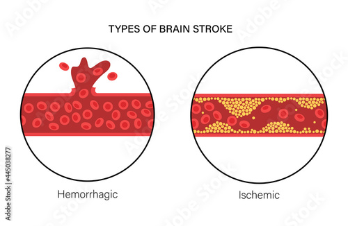 Brain stroke ishemic and hemorrhagic