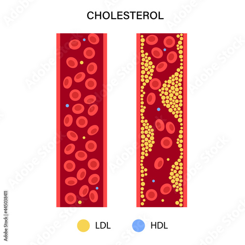 Cholesterol blood artery