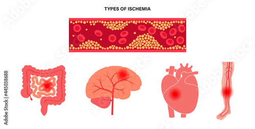 Types of ishemia