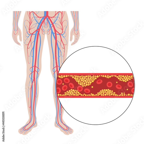 Peripheral artery disease