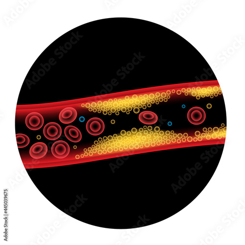 Cholesterol blood artery