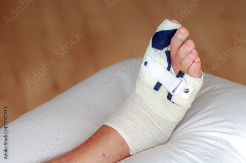 Health care concept, Foot surgery, Wrapped feet with plaster or pressure bandage after operation, Problem of right side feet with a bunion (also referred to as hallux valgus or hallux abducto valgus) photo
