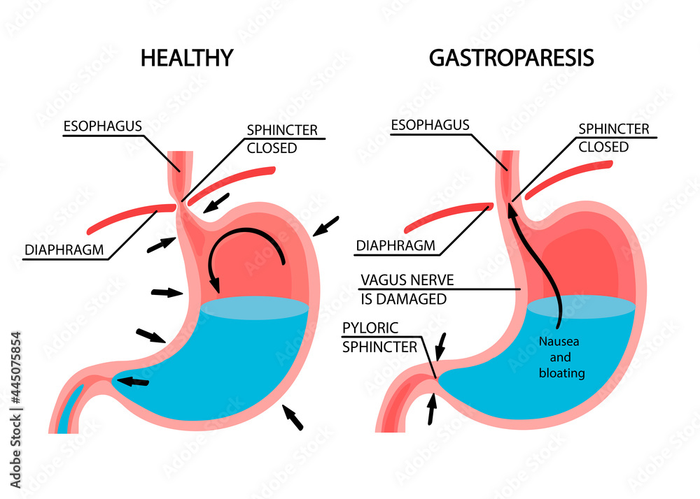 Visual Comparison Of Healthy Gastric And Stomach With Gastroparesis