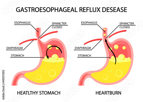 Human stomach. Gastroesophageal reflux disease. GERD, heartburn, gastric infographics. vector illustration in cartoon style
