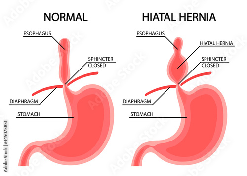 stomach disease. Diaphragmatic hernia. vector illustration in cartoon style