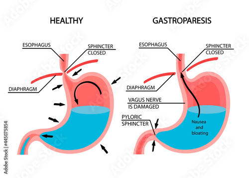 Visual comparison of healthy gastric and stomach with Gastroparesis.