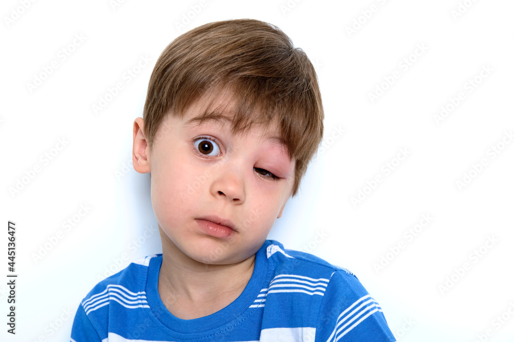 A boy with swollen eye from insect bite. Quincke edema. Portrait of Caucasian appearance child looking at the camera. Studio background. Isolated. Face of allergic person. Copy space. Studio. Allergy A boy with swollen eye from insect bite. Quincke edema. Portrait of Caucasian appearance child looking at the camera. Studio background. Isolated. Face of allergic person. Copy space. Studio. Allergy