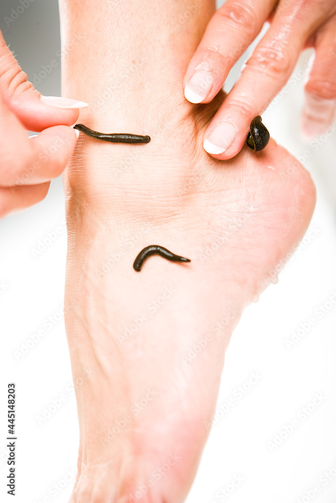 Leech therapy with medical leeches on human body. Naturopathy ...