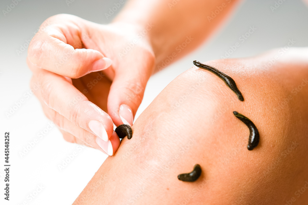 Leech therapy with medical leeches on human body. Naturopathy, healthcare,  natural medicine, good blood circulation. Stock Photo