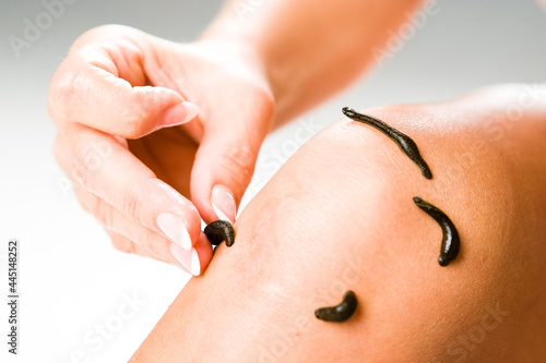 Leech therapy with medical leeches on human body. Naturopathy, healthcare, natural medicine, good blood circulation.