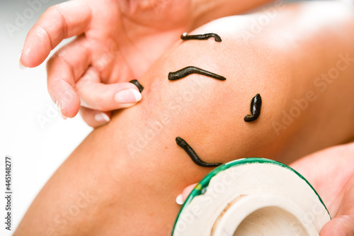Leech therapy with medical leeches on human body. Naturopathy, healthcare, natural medicine, good blood circulation.