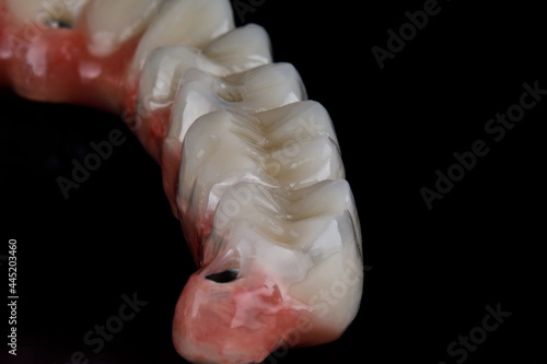 the chewing part of the ceramic prosthesis of the upper jaw close-up on a black background