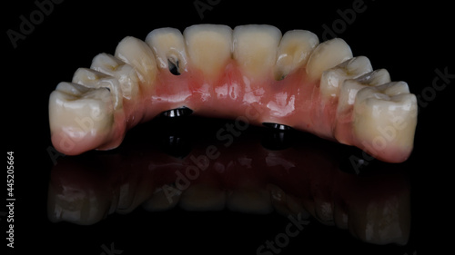 dental prosthesis made of ceramic and titanium, view from the outside on black glass