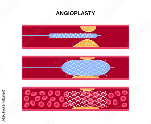 Angioplasty cardiac stent