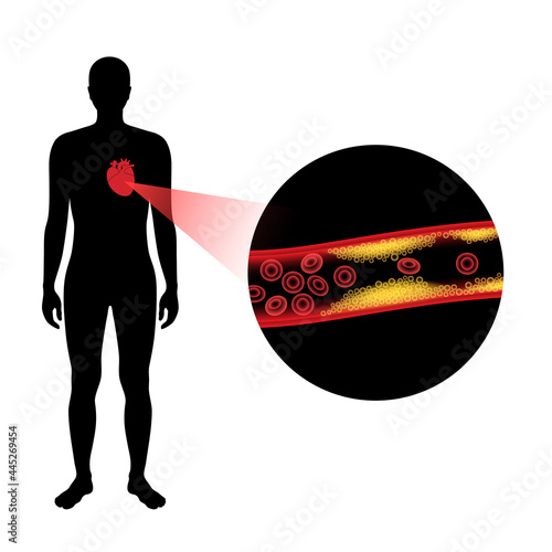 Cholesterol heart disease