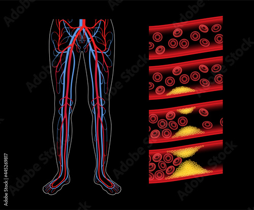 Peripheral artery disease