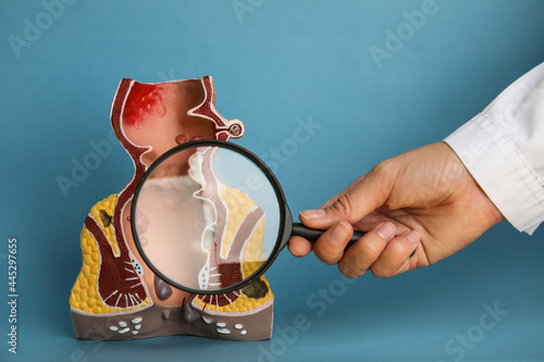 Proctologist holding magnifying glass near anatomical model of rectum with hemorrhoids on light blue background, closeup photo