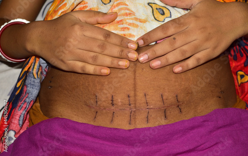 Close up of a scar on the belly created from Cesarean section or C-section or surgical delivery operation . a cesarean scar after one week . Delivery by Caesarean section selective focus. photo