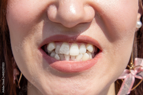 Curved female teeth, before installing braces. Close - up of teeth before treatment by an orthodontist photo