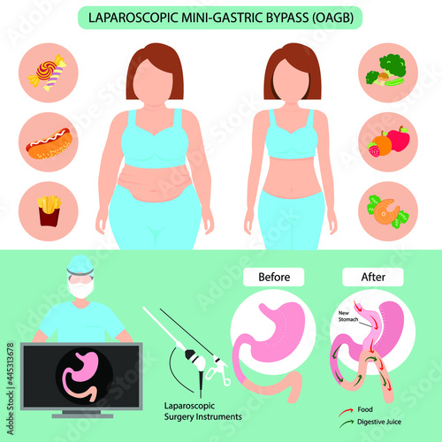 Infographic of Laparoscopic mini-gastric bypass (OAGB) illustration. Weight loss surgery vector.