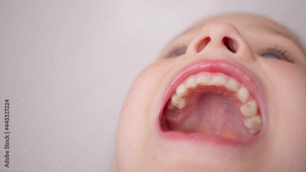 girl opens her mouth wide. child shows his teeth and mouth to dentist. mouth is wide open, tongue is stuck out as far as possible, with clear view of tongue and soft palate ▶0:18 ▶0:18   