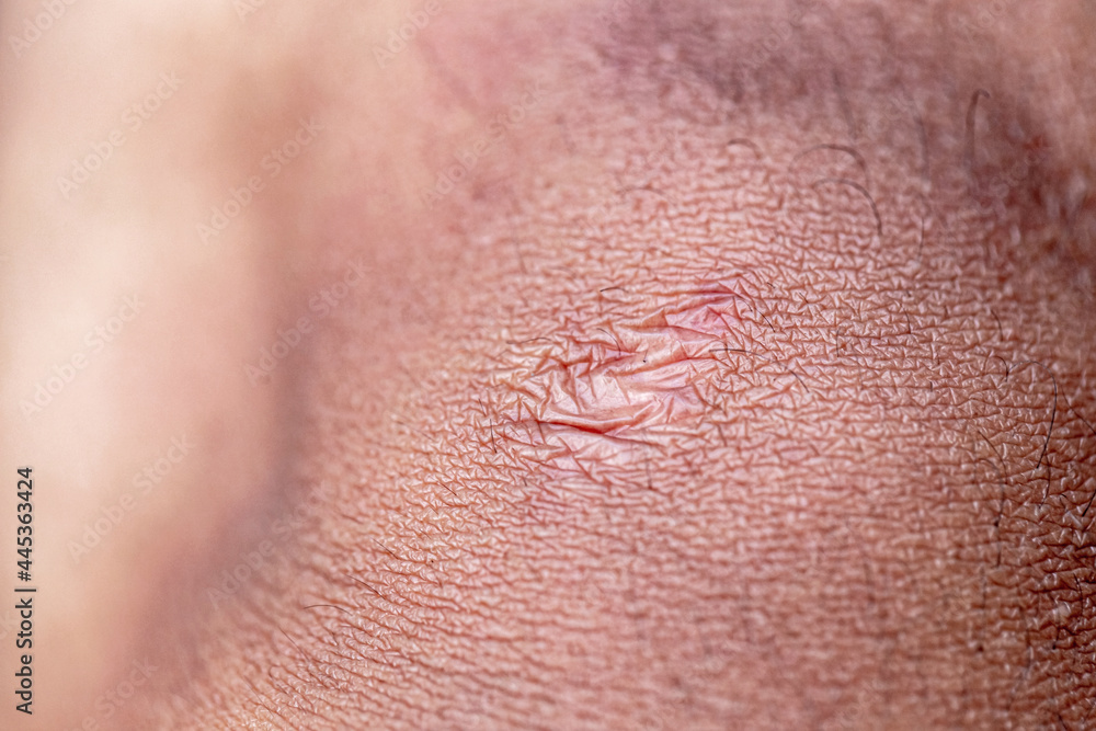 Fototapeta premium Close up of cyanotic keloid scar caused by surgery and suturing 