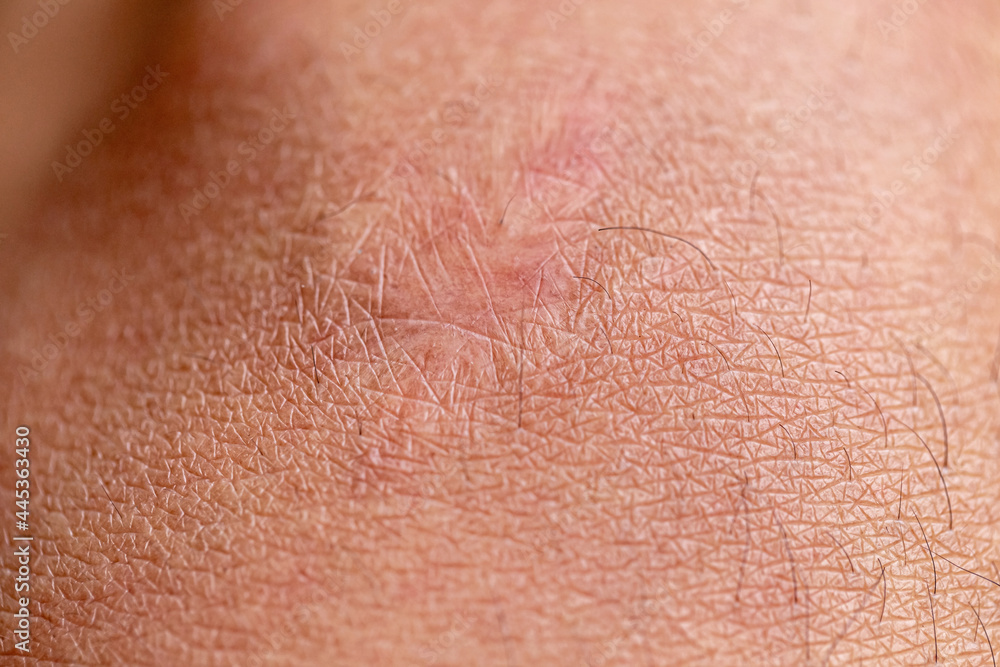 Close up of cyanotic keloid scar caused by surgery and suturing
Close up of cyanotic keloid scar caused by surgery and suturing