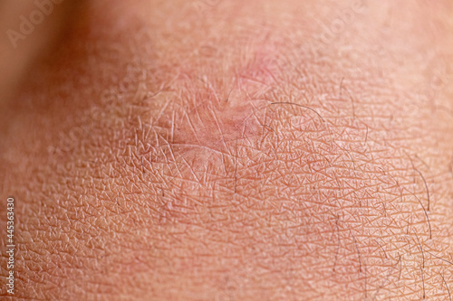 Close up of cyanotic keloid scar caused by surgery and suturing 