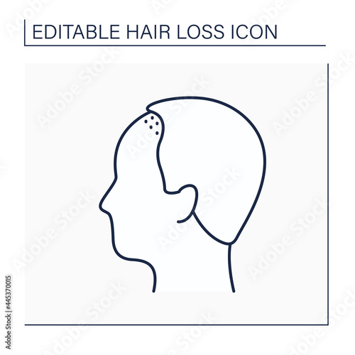 Hair loss line icon. Man loses hair above upper brow crease. Male pattern baldness. Alopecia concept. Isolated vector illustration. Editable stroke
