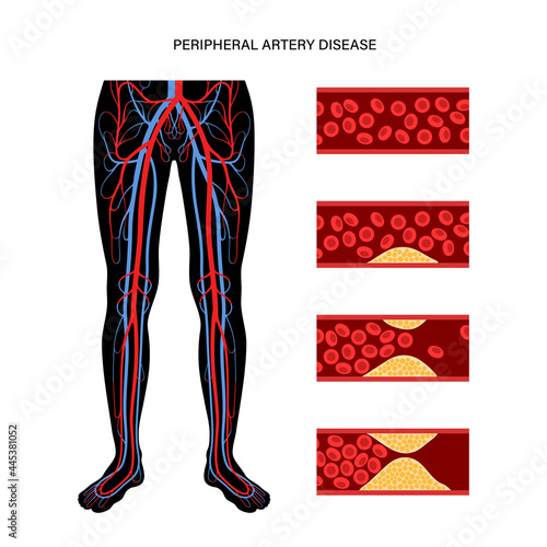 Peripheral artery disease