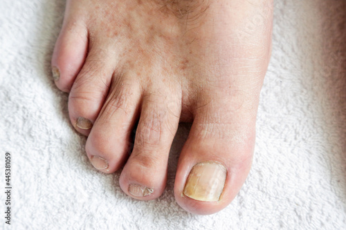 Details of man nails with fungal infection known as mycosis, natural light