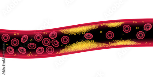 Cholesterol and atherosclerosis