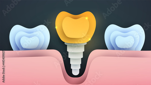 Human golden tooth implant silhouette in modern creative style. Luxury minimalistic design concept. Premium healthcare medical composition art element. Bright paper cut layer vector illustration.