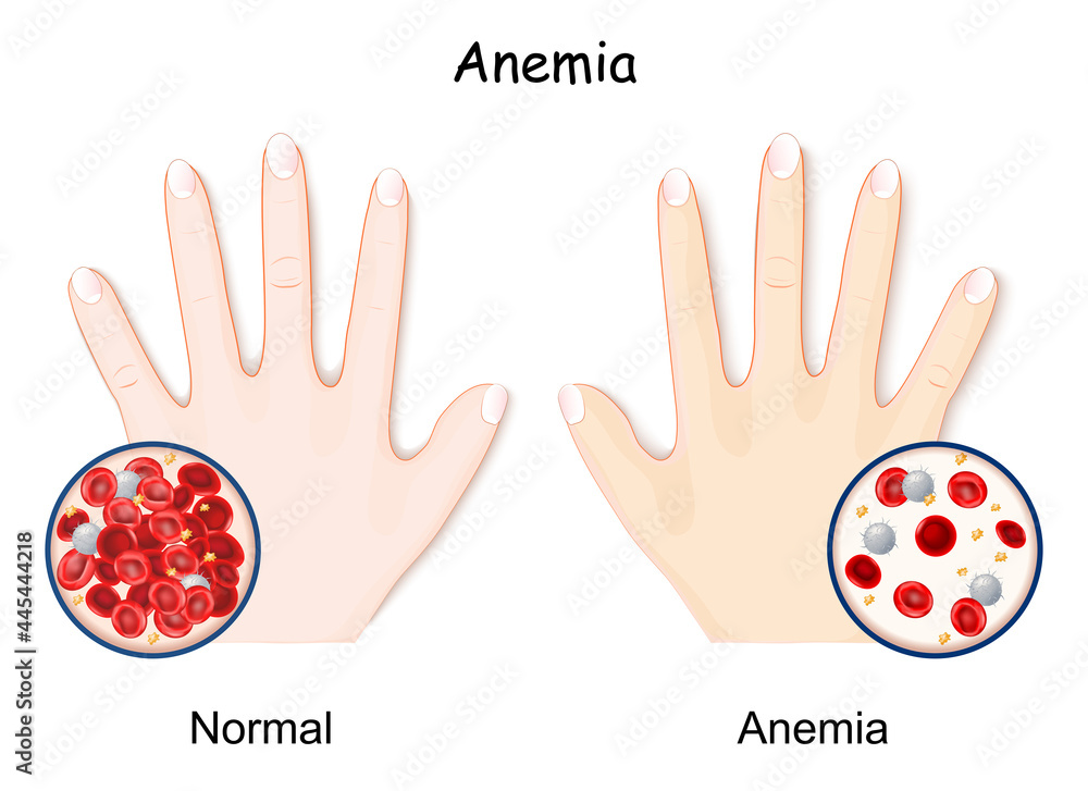 Anemia. hand of healthy human and anaemia Adobe Stock