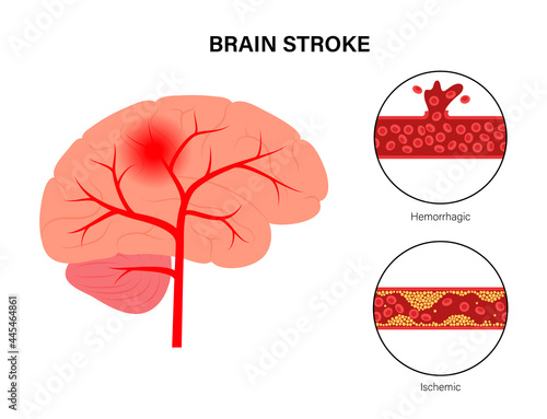 Brain stroke ishemic and hemorrhagic photo