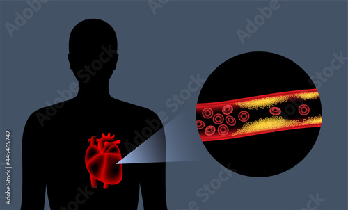 Cholesterol heart disease