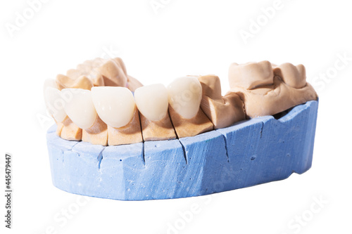 Veneers and crowns isolated on white background. Plaster model of teeth. lower jaw plaster model with prepared teeth. Working demountable plaster model. White front teeth veneers on diagnostic model photo