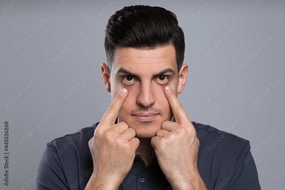 Man checking his health condition on grey background. Yellow eyes as symptom of problems with liver Man checking his health condition on grey background. Yellow eyes as symptom of problems with liver