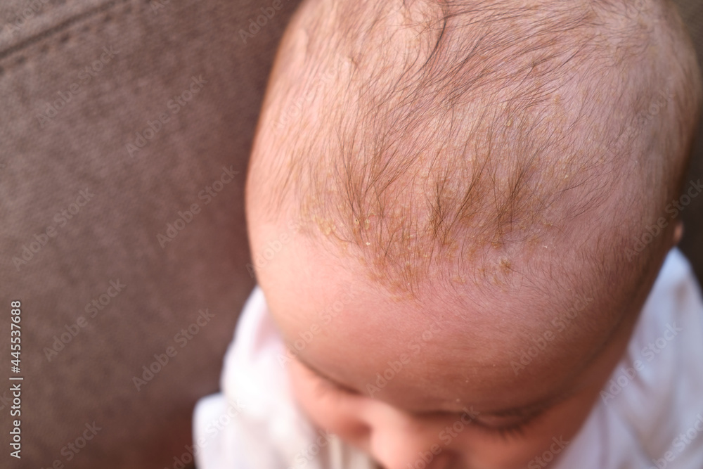 Cradle cap (seborrheic dermatitis) on the head of babies Stock Photo Adobe Stock
