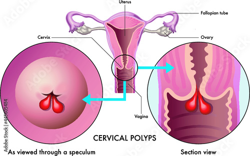 Medical illustration shows a female reproductive system with cervical polyps, with annotations.