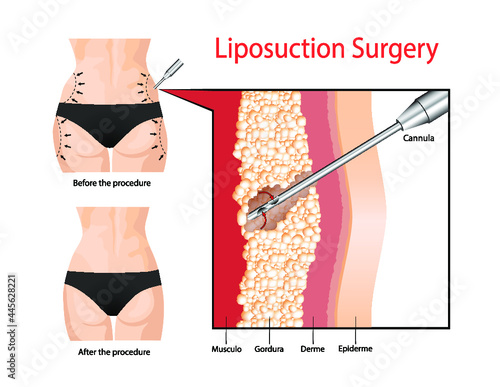 Liposuction. The operation to clean the fat layer under the skin.