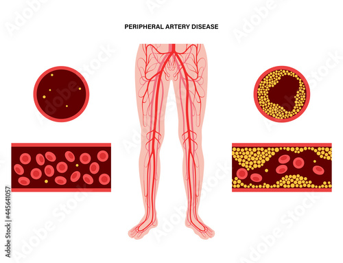 Peripheral artery disease