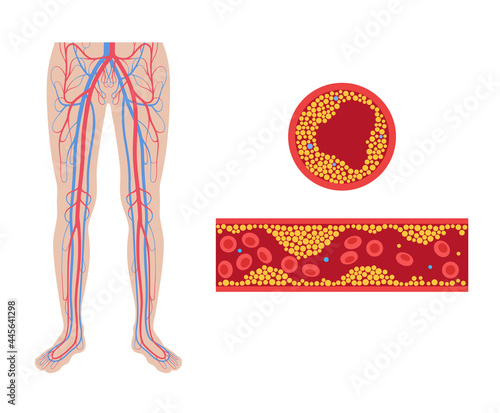Peripheral artery disease